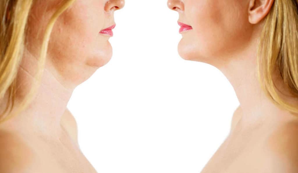 Double Chin treatment Epping before and after results