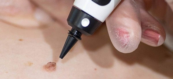 After Skin Tag Removal Epping