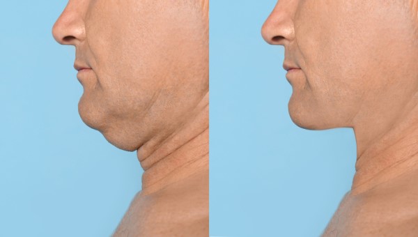 Which Non-Surgical Treatments Work Best for Jowls and Loose Skin Epping?