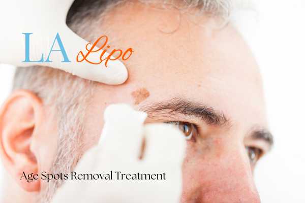 What Are the Most Effective Treatments for Age Spots Epping?