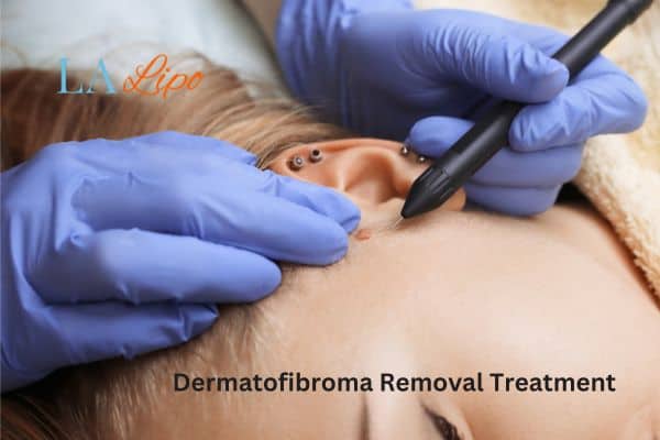 Dermatofibroma Removal Treatment Epping