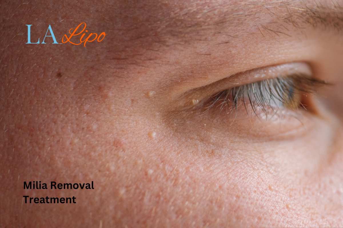Cryopen Milia Removal: Is It the Easiest and Safest Option Epping?