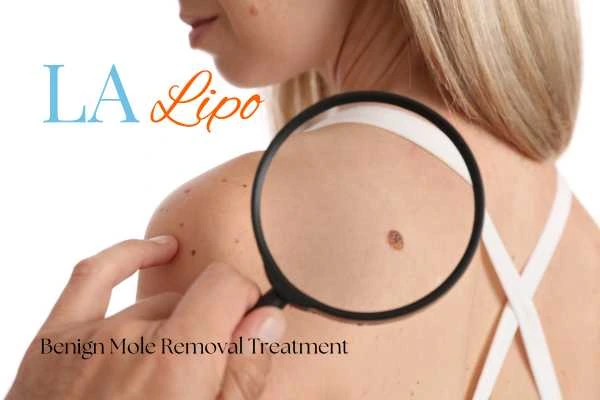 Woman having her inspection of blemish before mole removal Epping