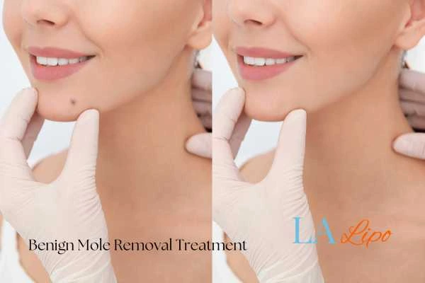 woman's before and after mole removal Epping results