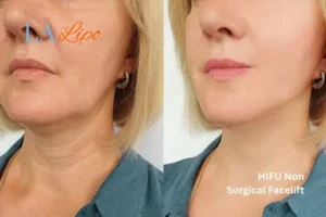 hi-fu for wrinkles Epping before and after results