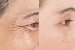 Before and after results of woman - HI-fu wrinkles reduction treatment Epping