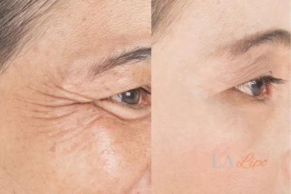 Before and after results of woman - HI-fu wrinkles reduction treatment Epping