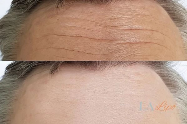 results of HIFU Epping on mans forehead to help reduce lines and wrinkles