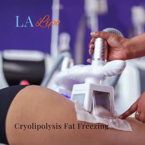 fat freezing - Cryolipolysis Epping