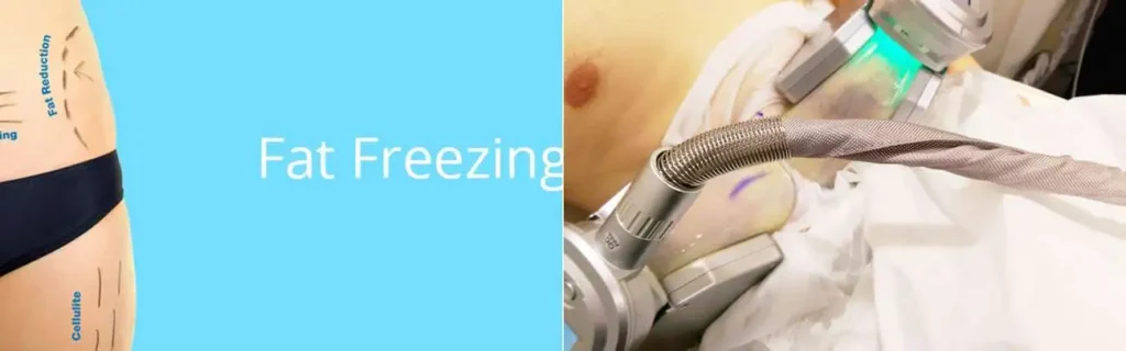 multi areas of a persons body having coolsculpting Epping treatment