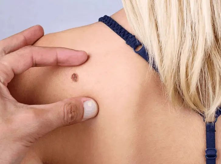 woman having mole removal Epping consultation before treatment.