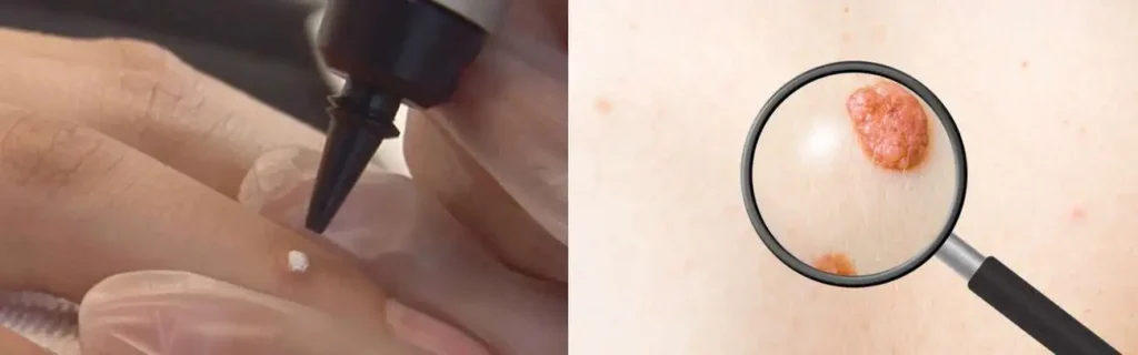 Cryopen for mole removal Epping - speak to our team today!