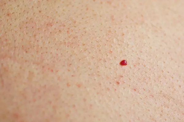 close up of a cherry angioma Epping