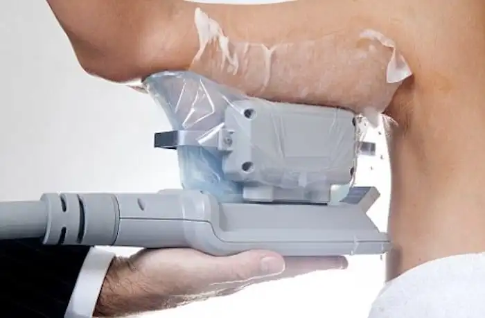 Picture of fat freezing Epping on the upper arms.