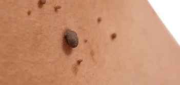 image of a skin tag Epping