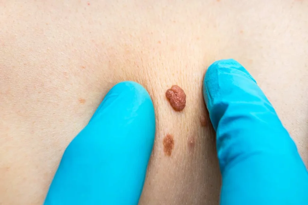 Consultant examining a skin tag Epping