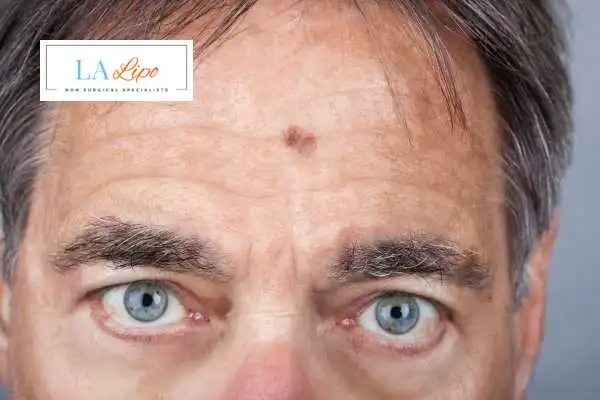 Solar Lentigo Removal Epping image of man with mark on his forehead