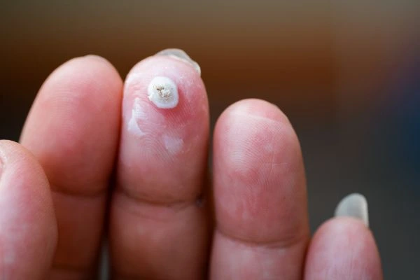 wart on person finger - cryotherapy to treat from LA LIPO Epping