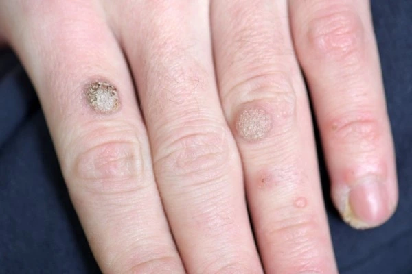 photo of warts on person hand - see wart removal Epping from LA LIPO