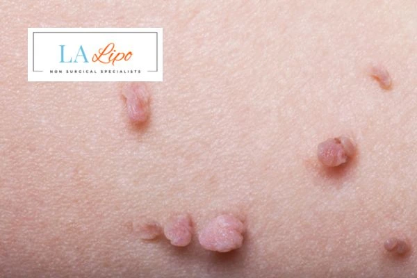 Does cryopen skin tag removal Epping hurt? Find out now call our team today!