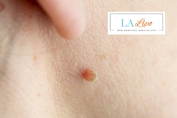 Book skin tag removal Epping today speak to our team now!