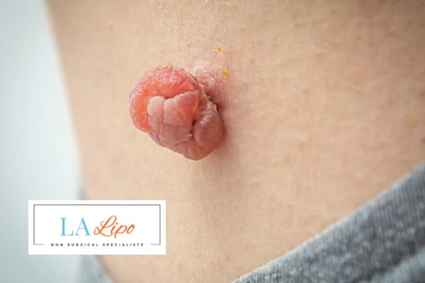 Interested in skin tag removal Epping? Concerned about the pain? Find out more today!