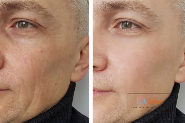 See the amazing results of Morpheus8 Treatment Epping!