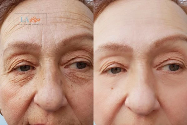 The powerful benefits of Morpheus8 Treatment Epping - Call Our team today!