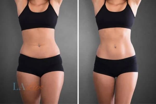 before and after results of non-surgical treatment to help a woman's body image and mental health Epping