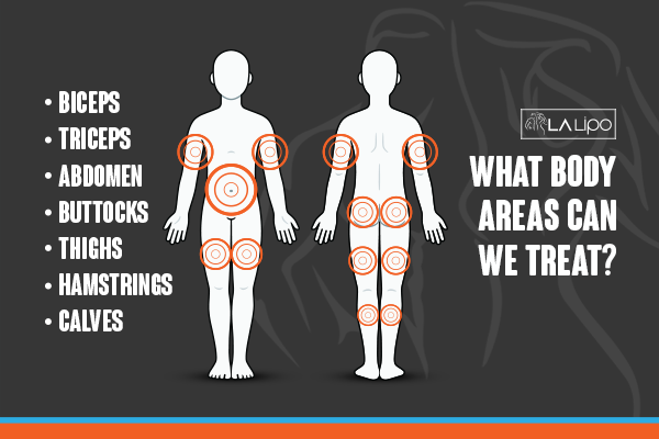 Diagram to show areas you can have LA-EMS Body Sculpting Treatment Epping