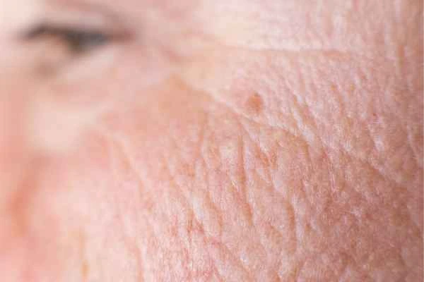 close up picture of a woman's face showing an age spot Epping
