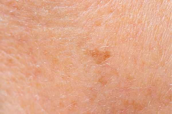close up picture of age spots Epping