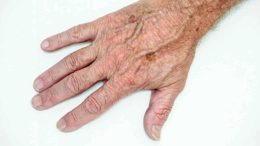 Male hand showing age spot Epping