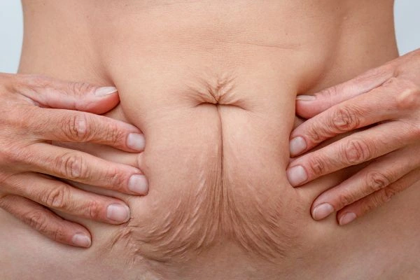 Image of a woman's stomach with loose skin - example of skin tightening Epping options