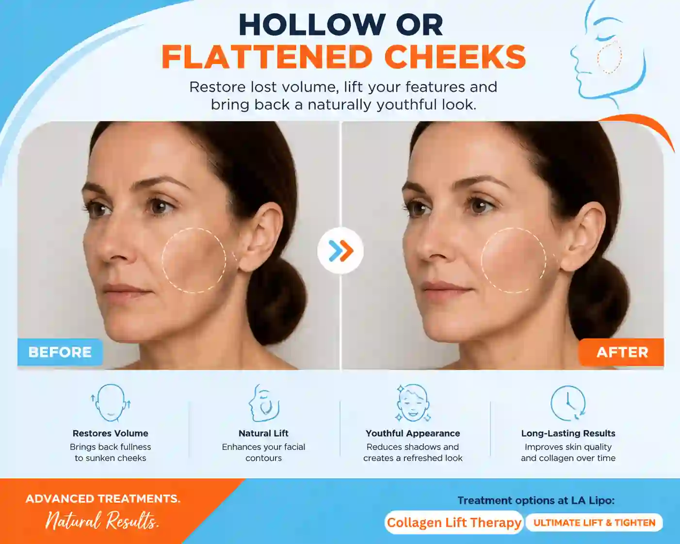 Sign #4: Hollow or Flattened Cheeks Epping